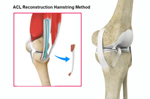 ACL Reconstruction Hamstring Method