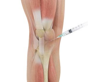 Cortisone Injection