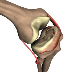 Meniscal Tears