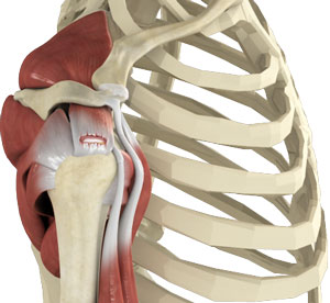 Rotator Cuff Tear Image Rotator Cuff Tear