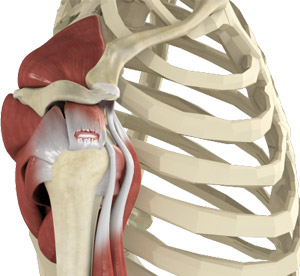 Rotator Cuff Tear