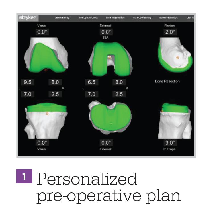 Mako Robotic-Arm Assisted Technology for total knee replacement