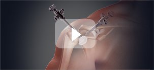 View More Shoulder Topic Videos